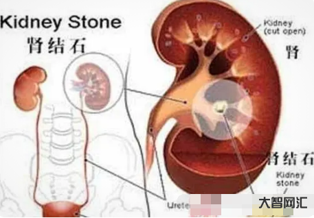 肾结石的症状有哪些症状-肾结石有哪些症状-大智网汇