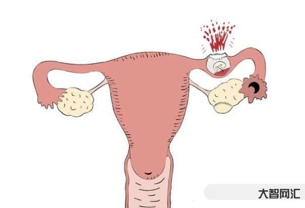宫外孕是什么原因造成的-女性宫外孕的原因有2点,老公也有责任,女人自己-大智网汇