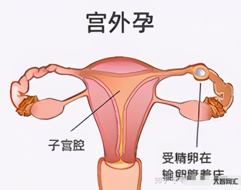 宫外孕的症状有哪些表现-医生提醒:孕妇有这2个异常,是宫外孕的表现,要-大智网汇