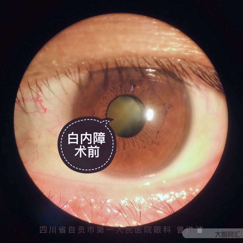 白内障的主要症状是什么-白内障患者的常见症状表现-大智网汇
