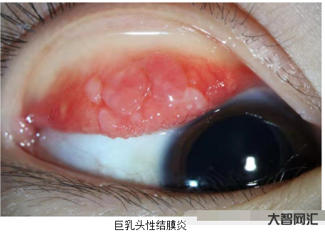 结膜炎有哪些症状-结膜炎的症状都有哪些 注意用眼卫生预防结膜炎-大智网汇