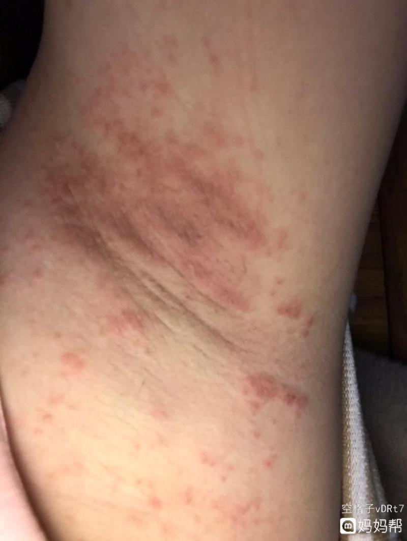 腋下有小疙瘩是什么原因-脖子和腋下的“小肉粒”是什么?能用手抠掉吗?看-大智网汇