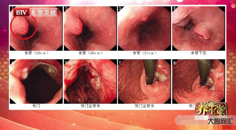 胃癌的早期症状有哪些-胃癌早期无症状?别再被骗了,3个前兆其实时刻在提-大智网汇