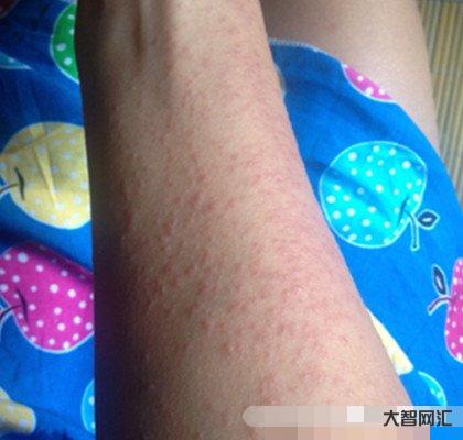 过敏了怎么办最快方法-皮肤瘙痒怎么办?教你解决这7种皮肤瘙痒的好方法-大智网汇