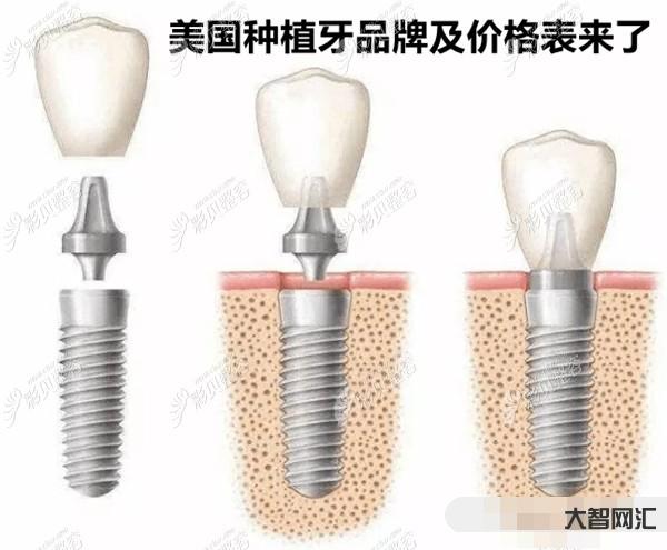 种植牙多少钱一颗2023年-种植牙降价啦!说说种植牙价格那些事-大智网汇