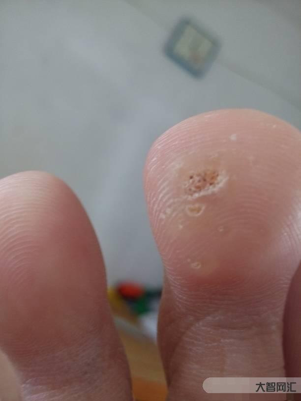 鸡眼怎么治能彻底根除-手上有鸡眼怎么除去?-大智网汇