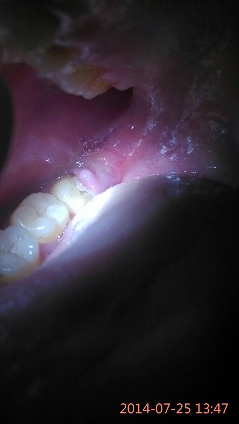 智齿牙龈发炎肿痛怎么办-拔智齿解决牙龈肿痛问题-大智网汇