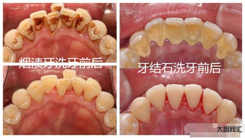洗牙齿有什么好处和坏处-“洗牙”对牙齿有伤害吗?医生:6类人群尽量别洗-大智网汇