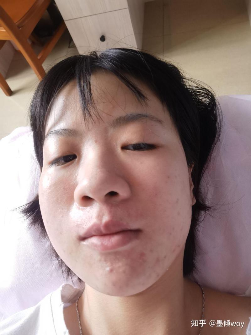 怎么样去痘-痘痘总是反复无常?改掉这些祛痘误区,8个实战妙招告别痘痘脸-大智网汇