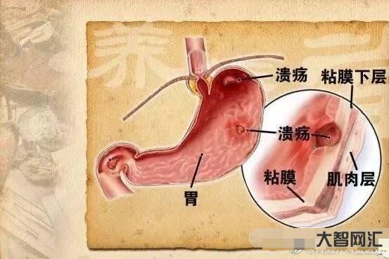 胃溃疡症状表现有哪些-胃溃疡有哪些症状?如何治疗?-大智网汇